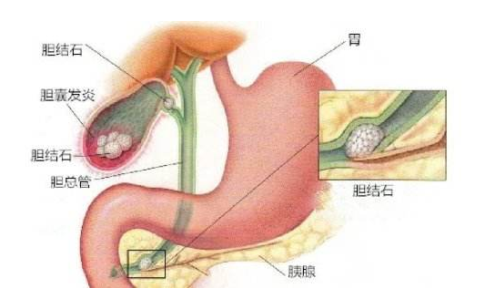 胆结石的食疗方法 如何预防胆结石